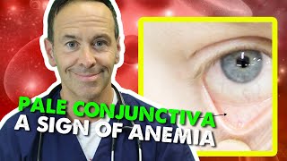 Pale Conjunctiva  A Sign of Anemia [upl. by Nivahb]