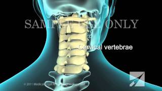 Lumbar Laminectomy [upl. by Faxon]