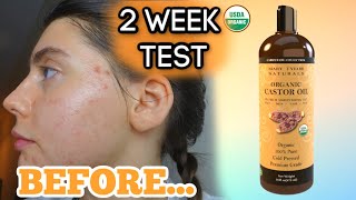 I TESTED PURE CASTOR OIL ON MY FACE FOR MY ACNE SCARS FOR 2 WEEKS  My review and thoughts [upl. by Faunie]