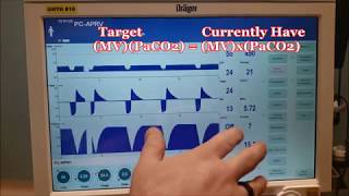 Modes of Mechanical Ventilation  Respiratory Therapy [upl. by Yrrem]