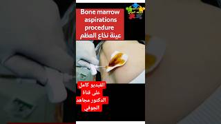 bone marrow aspiration procedure عينة من نخاع العظم shorts [upl. by Aibonez]