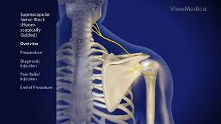 Suprascapular Nerve Block Fluoroscopically Guided  Pain amp Wellness Centers of Southern California [upl. by Emalee411]