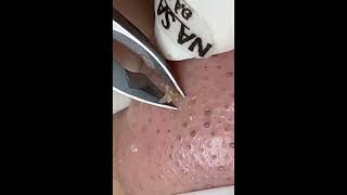 Nose WhiteHeads Masterful Extraction Blackheads Removal Videos 2022  5 [upl. by Lyrrehs]