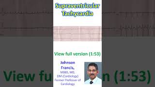 Supraventricular Tachycardia [upl. by Ries]