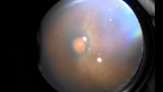 Indirect Ophthalmoscopes with Camera Neitz BSCAMERA and IOa LED CAMERA sample video [upl. by Neenahs]