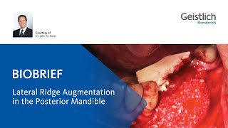 Lateral Ridge Augmentation in the posterior Mandible [upl. by Darsie510]