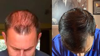 Hair Restoration Laboratories Shampoo Before and After Does It Work [upl. by Zerk]