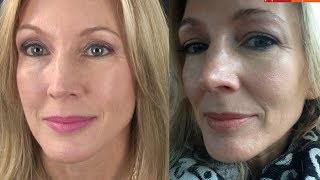 My Experience With Botox amp Filler Juvederm [upl. by Veriee]