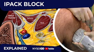 IPACK Block  Regional anesthesia Crash course with Dr Hadzic [upl. by Ysle]