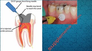 supplemental injection technique [upl. by Atok661]