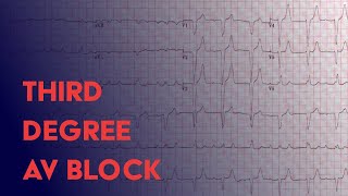 Third Degree Complete Heart Block  EKG ECG Interpretation [upl. by Kondon]