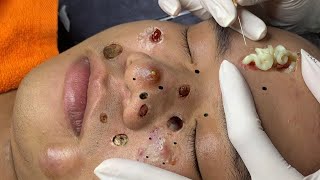 blackheads new 2023  popping pimple today  blackheads and whiteheads removal [upl. by Zeuqram]