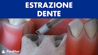 Estrazione dente – Conservazione del alveolo © [upl. by Eiramaliehs]