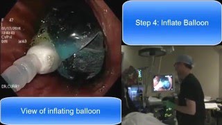 Orbera Gastric Balloon Live 2016Dr Trace Curry Cincinnati Ohio [upl. by Ailliw738]