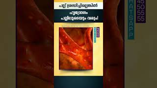 പല്ല് ശ്രദ്ധിച്ചില്ലെങ്കിൽ ഹൃദ്രോഗം പല്ലിലൂടെയും വരും [upl. by Eynaffit]