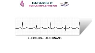 Ecg features of pericardial effusion amp electrical alternans [upl. by Ainegue]