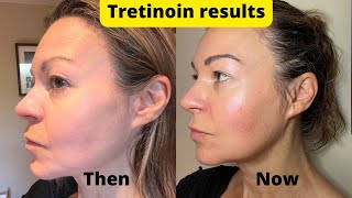 Dermatica tretinoin 6month results update  plus how to manage sun sensitivity [upl. by Naylor]