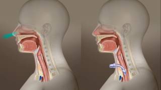 Tracheotomy Care How to Manage Accidental Decannulation [upl. by Gilli]