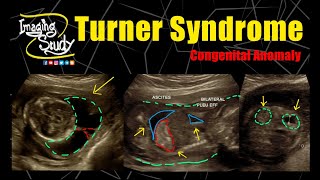 Turner Syndrome  45X  Monosomy X  Ultrasound  Anomaly  Case 276 [upl. by Nage]