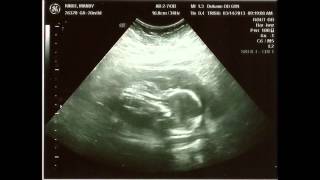 Fetal Heartbeat at 21 Weeks [upl. by Elfreda]