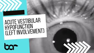 Acute Vestibular Hypofunction Spontaneous Nystagmus Left [upl. by Drews]