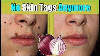 Remove Skin Tags just 30 second  how to remove skin tags fast 100 Works 1 [upl. by Assed]