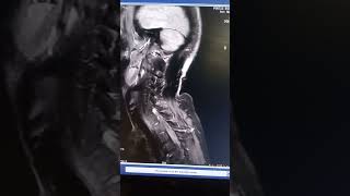 CEMRI BRACHIAL PLEXUS SEQUENCE [upl. by Ursel430]