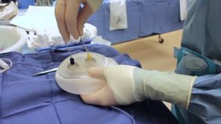 AlloX2 Tissue Expander for Breast Reconstruction [upl. by Hctim]