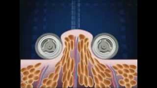 How Endermologie® works lipomassage [upl. by Janela]