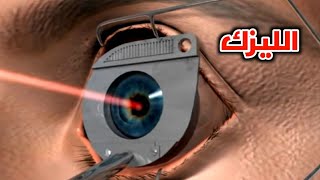 شاهد كيف تتم عمليه تصحيح النظر بالليزرالليزكWatch laser vision correction surgery LASIK [upl. by Palumbo946]