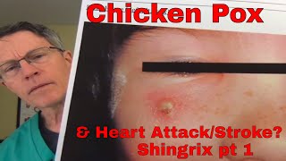 Shingrix part 1 A Childhood Virus Causing Heart Attack Stroke and Blindness  FORD BREWER MD MPH [upl. by Zile966]