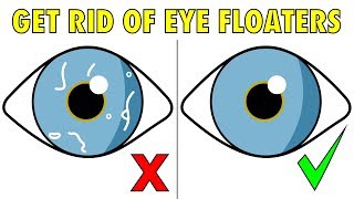 The 2 step solution to naturally get rid of eye floaters [upl. by Aihsekat18]