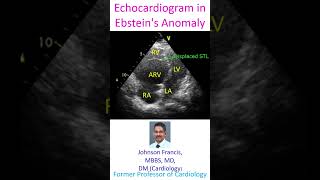 Echocardiogram in Ebsteins Anomaly [upl. by Nylsoj664]