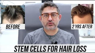 STEM CELL Hair Restorations 2 Year Updates Multiple Patient Success Stories [upl. by Rani]