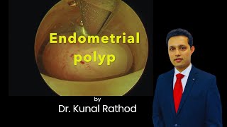 Myosure Polypectomy  Dr Kunal Rathod [upl. by Drusie7]