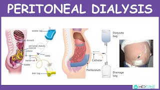 Peritoneal Dialysis Preparing for Peritoneal Catheter Placement Surgery [upl. by Giordano]