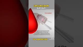 Understanding Circumcision Animated Surgery amp Real Insightsquot [upl. by Ahsaek]