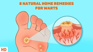 What are warts  Infectious diseases  NCLEXRN  Khan Academy [upl. by Zonnya]