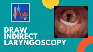 Draw Indirect Laryngoscopy Findings [upl. by Airdnaid]