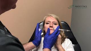 Juvederm Voluma Treatment Video [upl. by Yaf906]