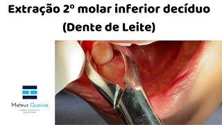 Extração 2º molar decíduo Dente de Leite [upl. by Attelrahs]