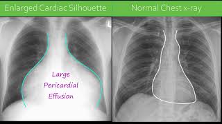 Chest xray  Pericardial Effusion [upl. by Muhcan]