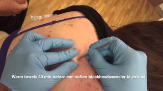 Blackheads back removal  the Australian Anaconda [upl. by Pavlov]