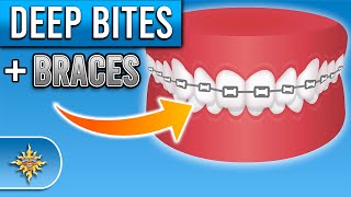 How Do Braces Fix Deep Bites  Premier Orthodontics [upl. by Neeneg556]