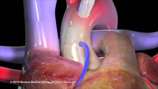 Coronary Artery Bypass Grafting CABG [upl. by Hendrickson45]