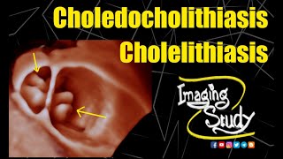 Cholelithiasis with Choledocholithiasis  Ultrasound  3D  Case 299 [upl. by Eliga]