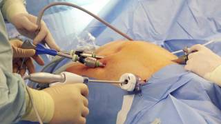 What are the advantages of a robotic surgery [upl. by Donatelli]