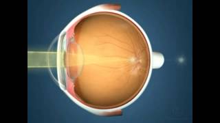 What is Astigmatism [upl. by Haduj]