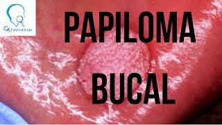 Papiloma Bucal  lesão relacionada ao HPV [upl. by Attenod918]