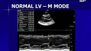 Assessing Left Ventricular Function [upl. by Ereveneug208]